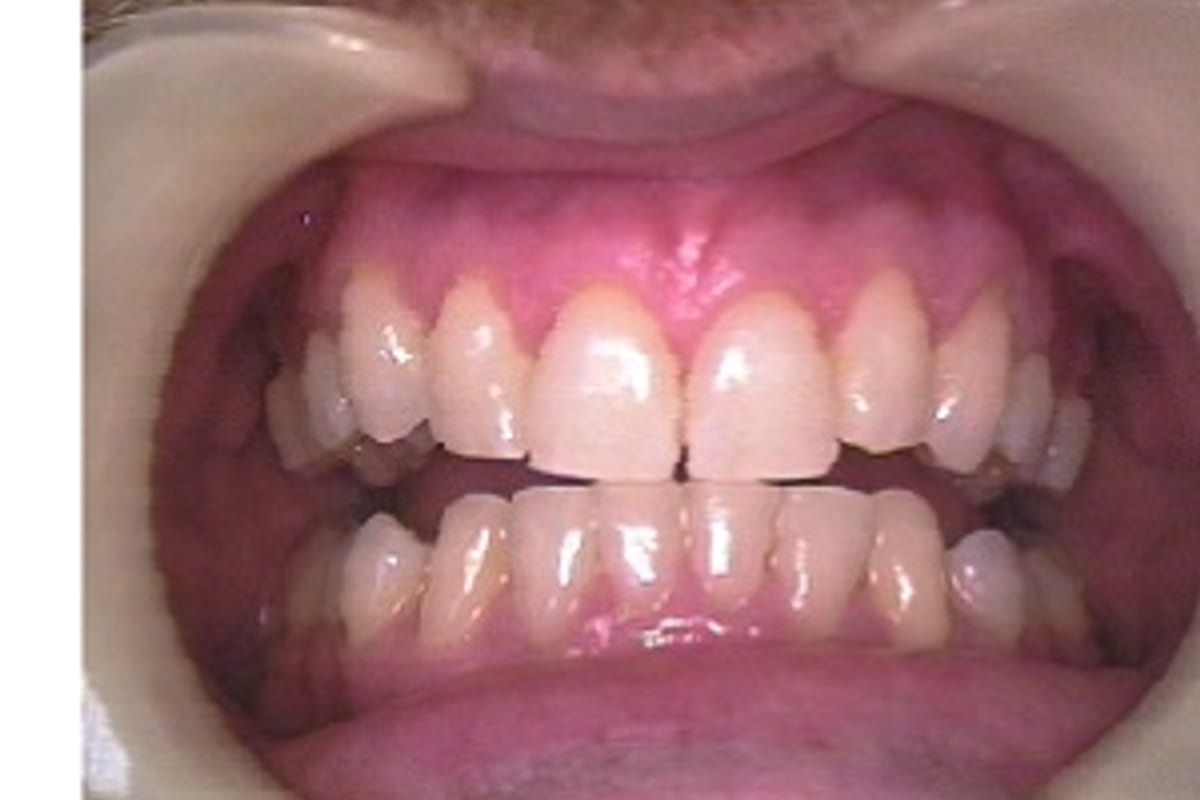After orthodontic reference image with improved alignment