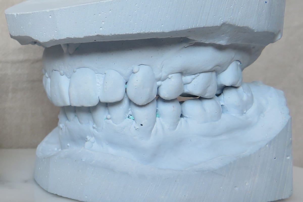 After orthodontic dental cast reference image