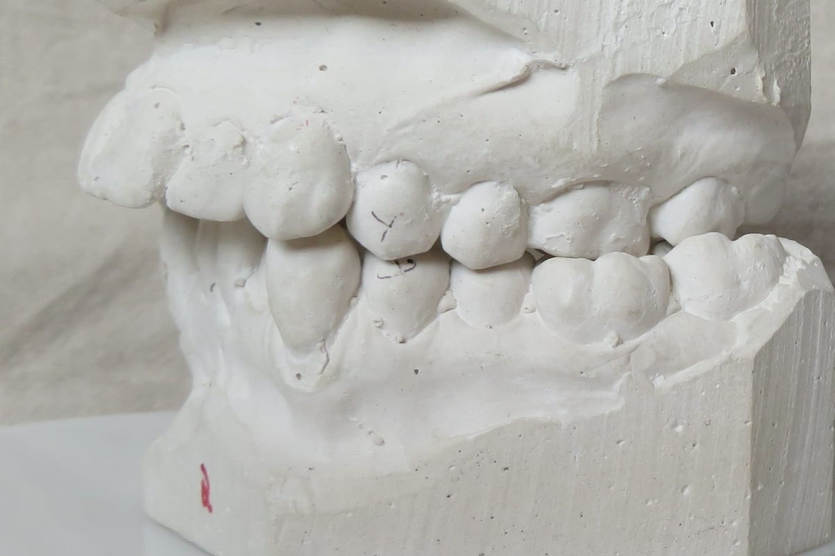 Before orthodontic dental cast reference image