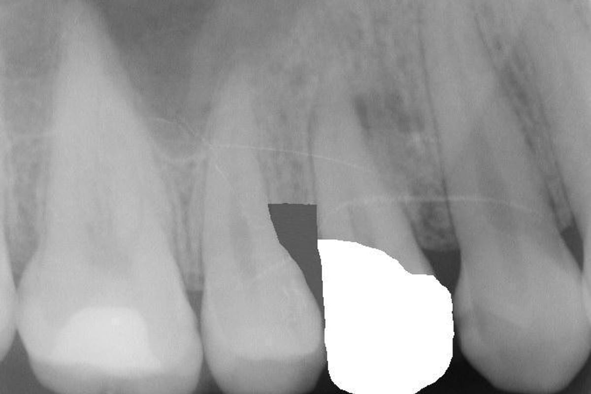 After dental radiograph reference image with crown planning overlay