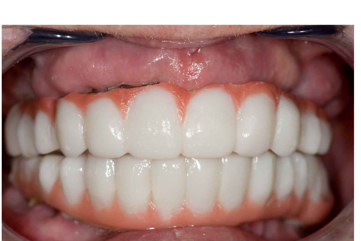 After full-mouth rehabilitation reference image