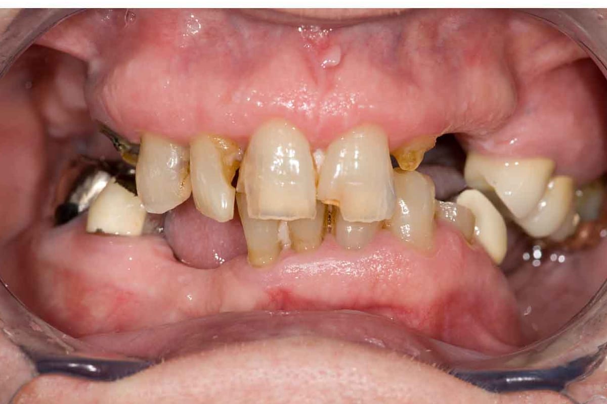 Before full-mouth rehabilitation reference image