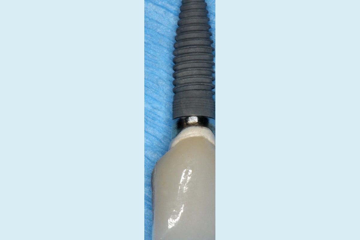 Dental implant crown and abutment reference image