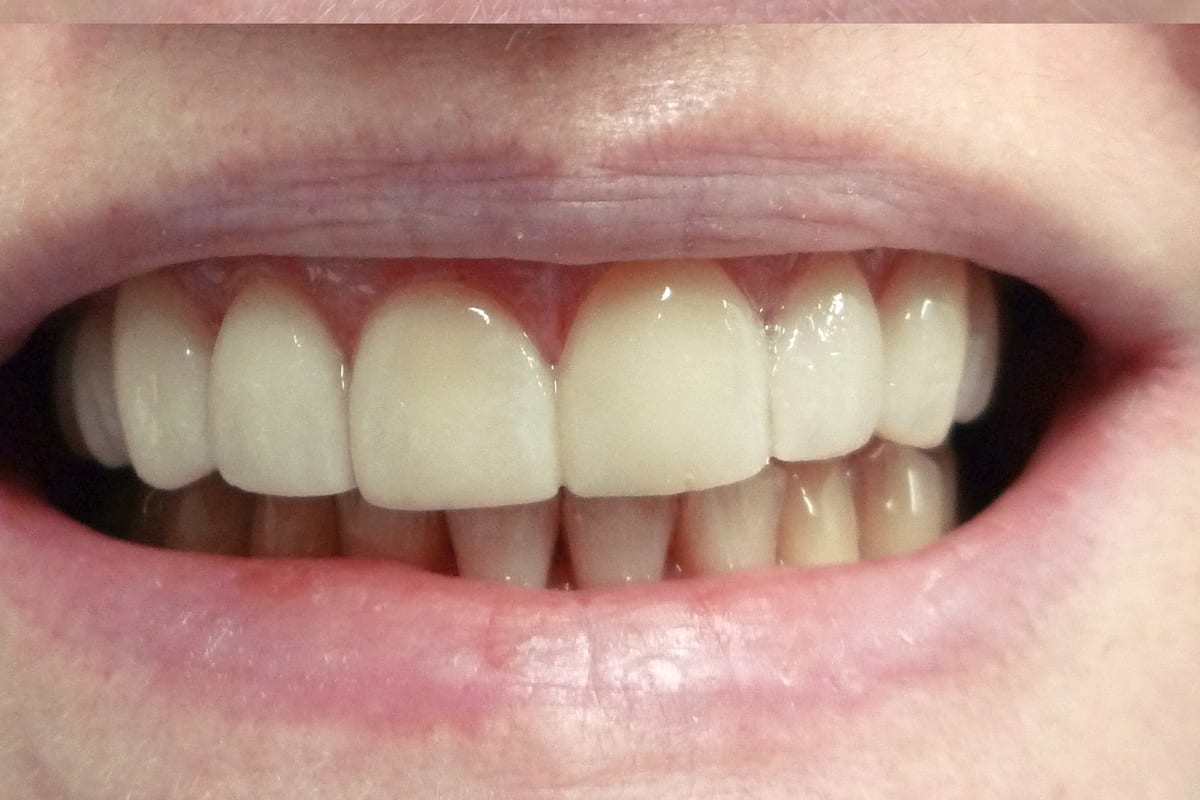 After reference image showing teeth after veneer treatment