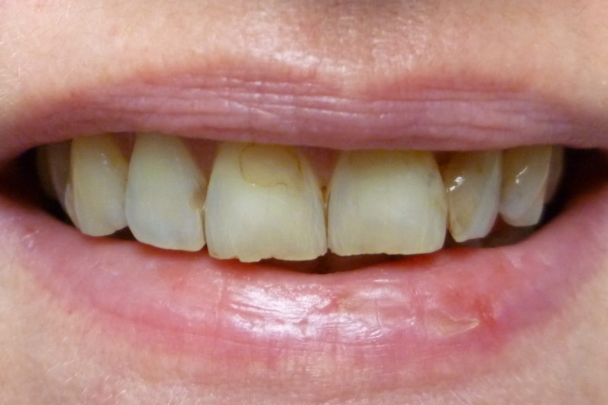 Before reference image showing teeth before veneer treatment